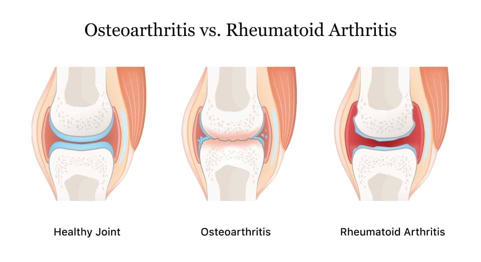 What Does Arthritis Means?